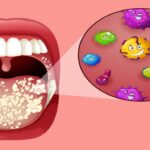 علاج فطريات الفم واللسان عند الأطفال والكبار وأسرع طرق التخلص منها
