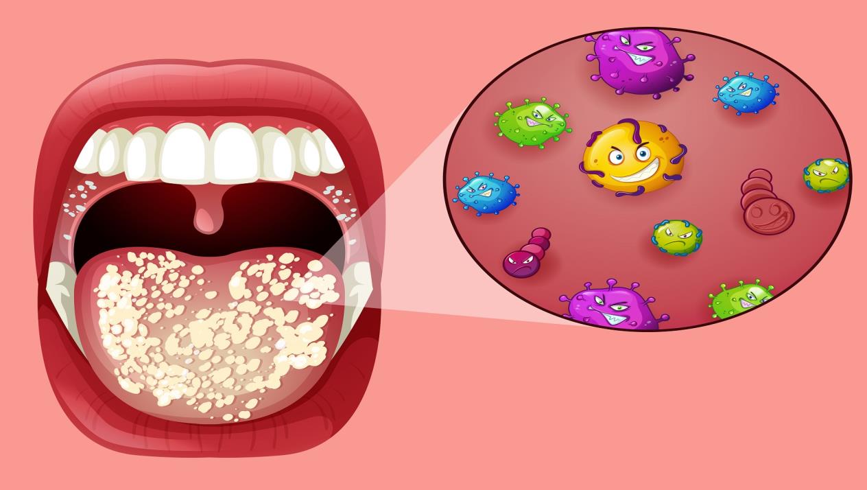 علاج فطريات الفم واللسان عند الأطفال والكبار وأسرع طرق التخلص منها‎