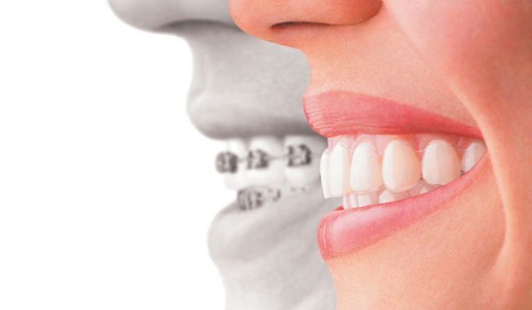 تقويم الأسنان طريقك لإبتسامة صحية بيضاء‎