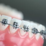معلومات حول تقويم الاسنان