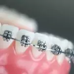 معلومات حول تقويم الاسنان
