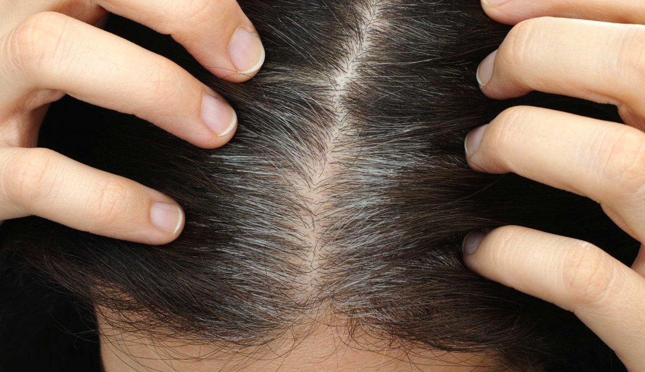علاج شيب الشعر المبكر.. كيف يؤثر التوتر على تحويل شعرك للون الأبيض؟‎