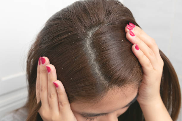وصفات التخلص من قشرة الشعر