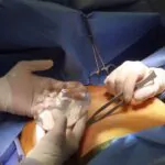 ما هي مضاعفات ومخاطر عملية تكبير الثدي؟