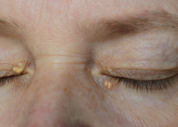 أعراض ارتفاع الكوليسترول في الدم