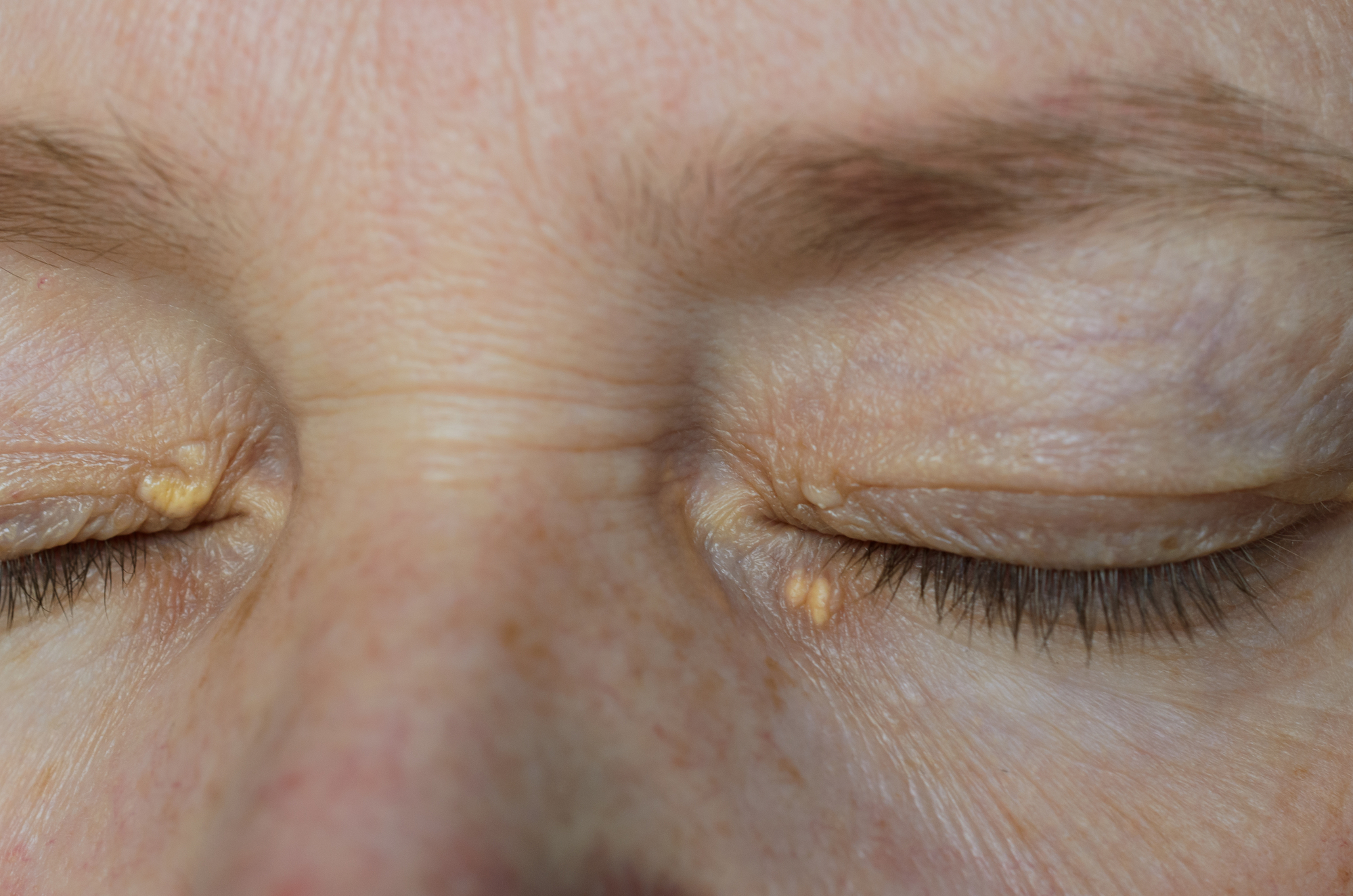 علامات ارتفاع نسبة الكوليسترول التي تظهر في عينيك وحولها