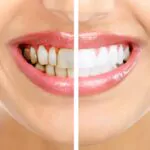 أكثر الحلول فعالية في تبييض الأسنان