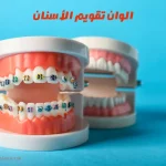 الوان تقويم الأسنان| كيفية اختيار افضل ألوان تقويم الأسنان للبنات وللبشرة البيضاء والسمراء والقمحية وللرجال