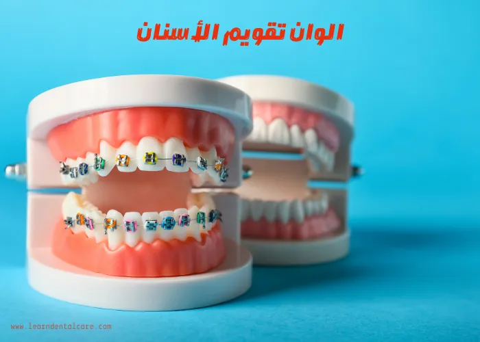 الوان تقويم الأسنان| كيفية اختيار افضل ألوان تقويم الأسنان للبنات وللبشرة البيضاء والسمراء والقمحية وللرجال‎